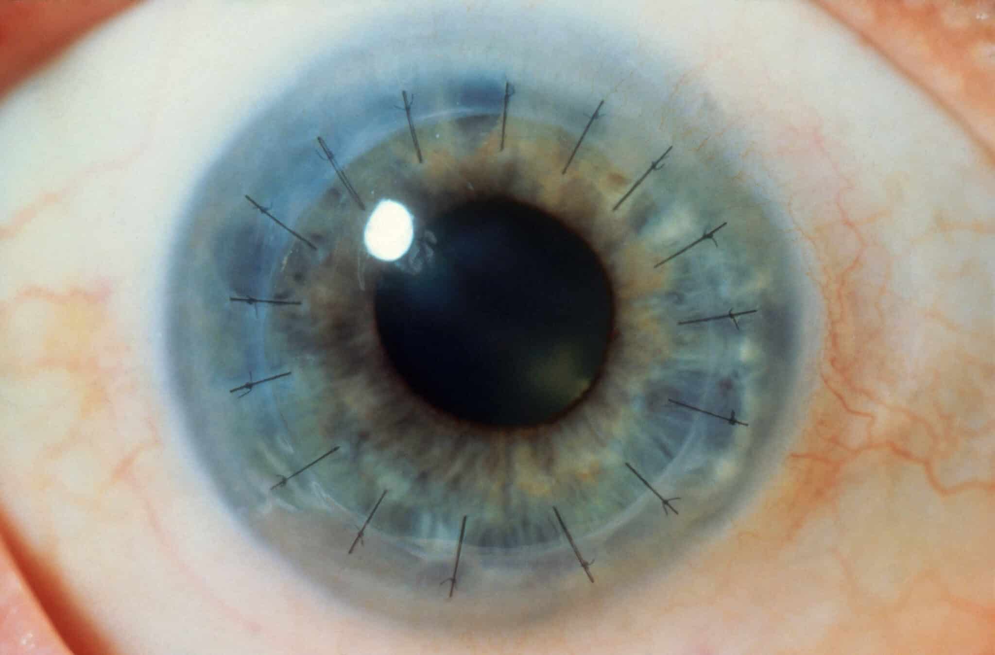 Addio al trapianto di cornea, nel 40% dei casi basterà un'iniezione di cellule endoteliali